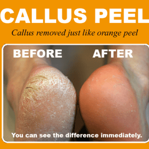 Callus Peel - Image 5